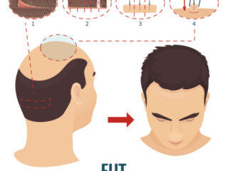 procedure-of-fut-hair-transplant-1